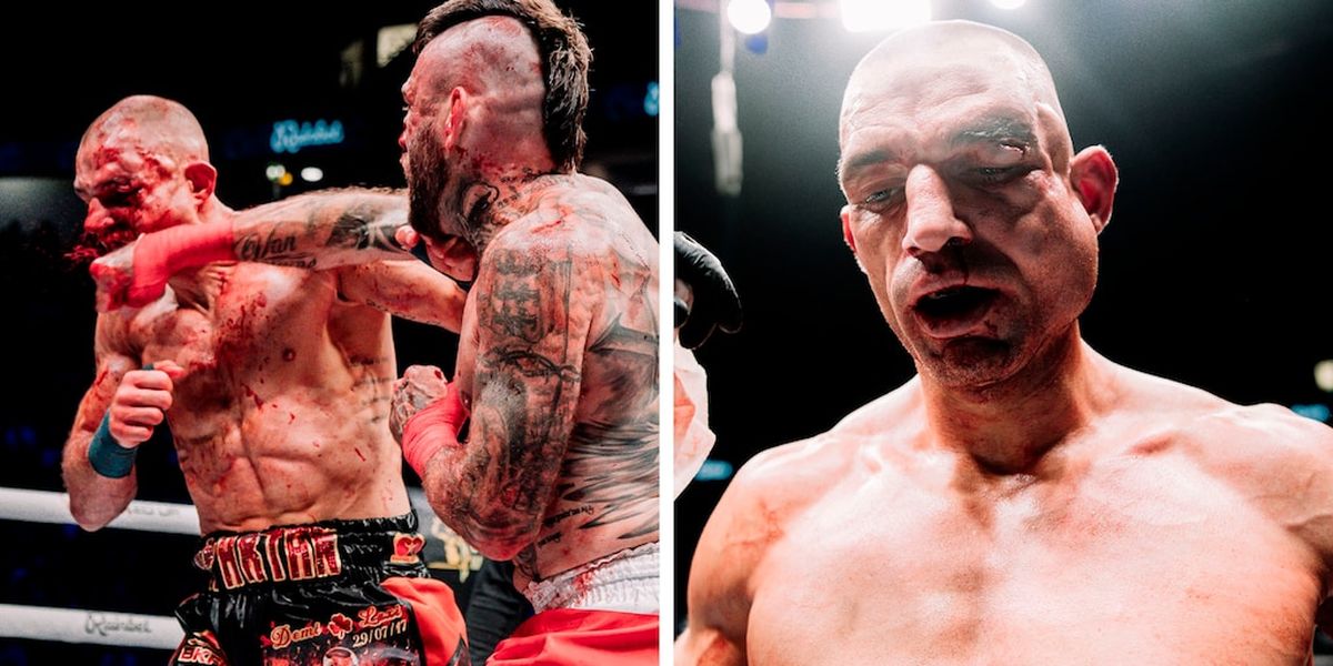 Ste Wallwork sufre inflamación facial severa durante su debut en BKFC.